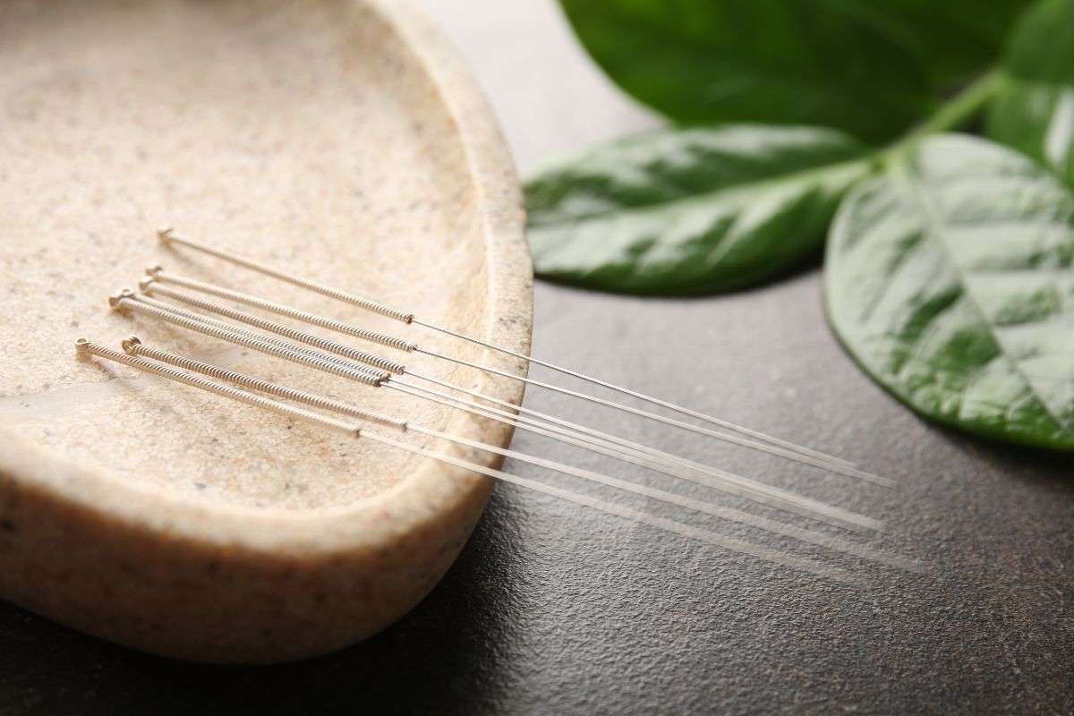 Acupuncture session showing fine needles placed on the body to relieve pain, improve circulation, and promote natural healing in a professional clinic.