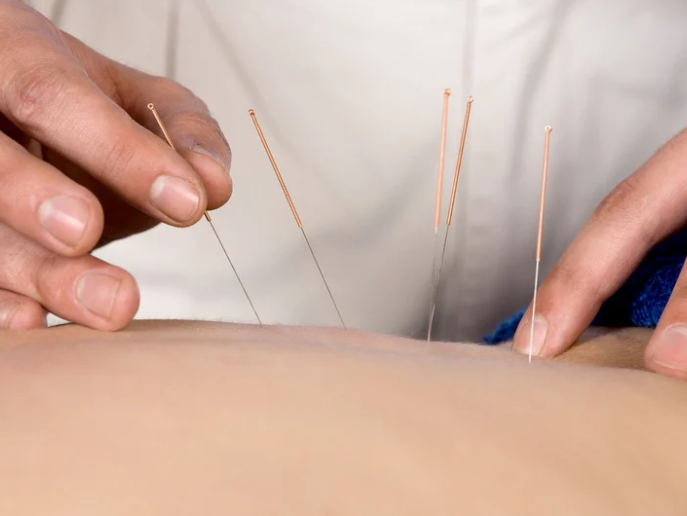 A calming acupuncture session with tiny needles therapy in NYC clinic